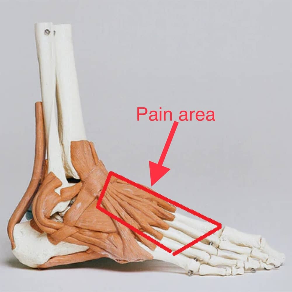 Extensor Tendonitis - What Is It?
