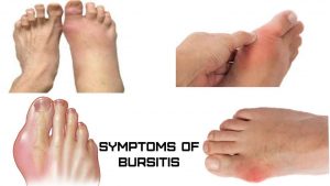 symptoms of bursitis