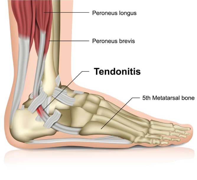What Is Foot Tendonitis