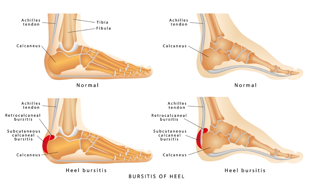  bursitis of the foot 