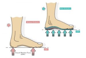 Treating Bursitis Heel - Orthotics